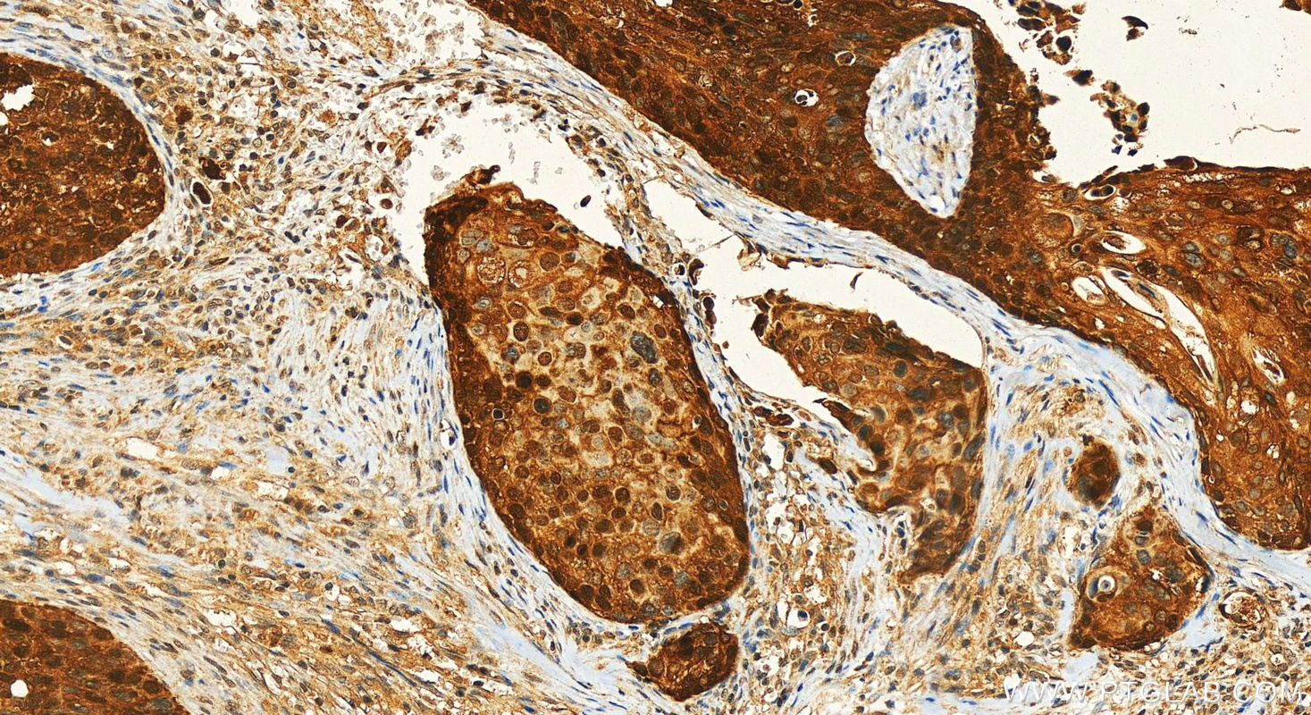 IHC staining of human cervical cancer using RMX00038 IHC staining of human cervical cancer using RMX00038