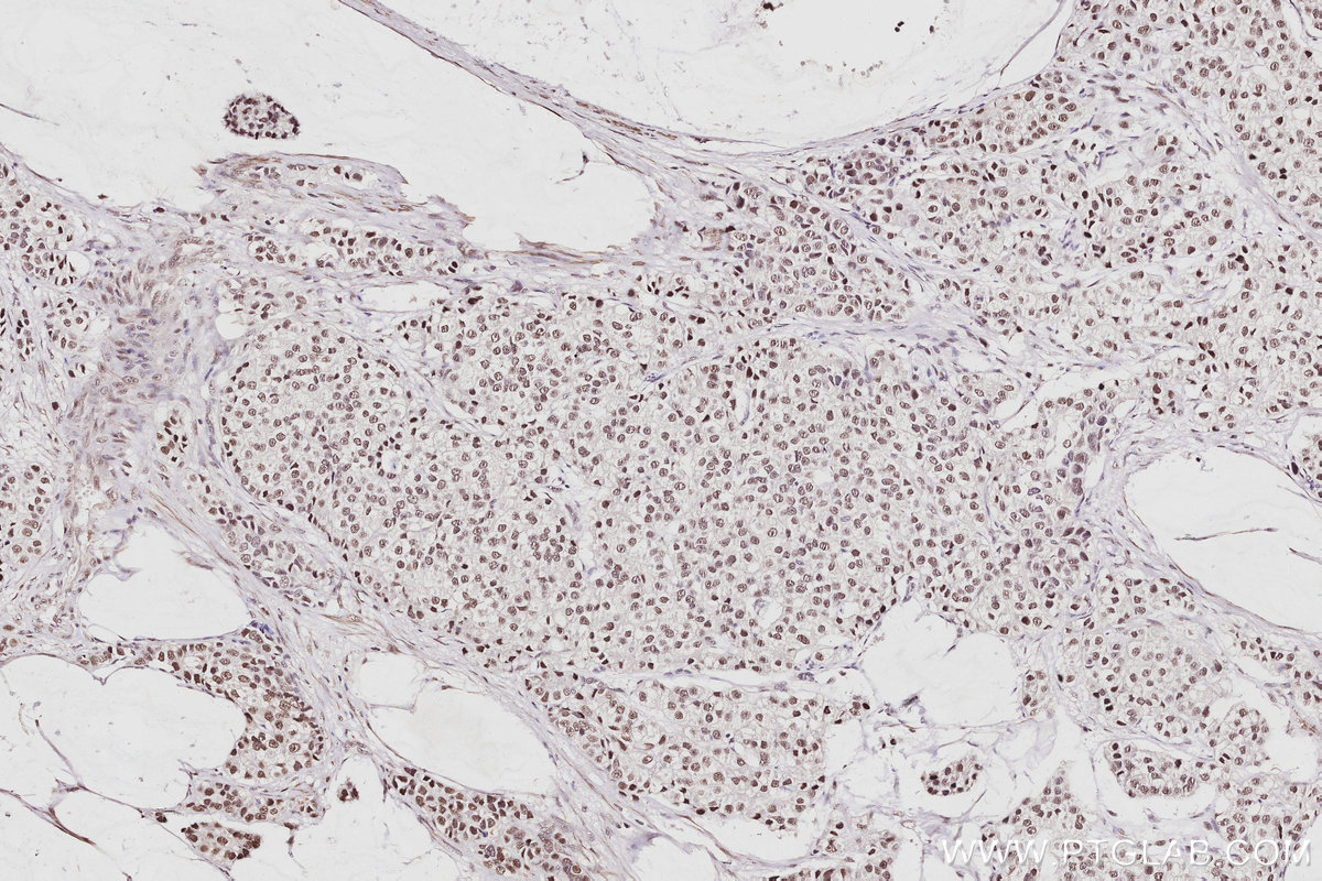 IHC staining of human stomach cancer using 16615-1-AP IHC staining of human stomach cancer using 16615-1-AP