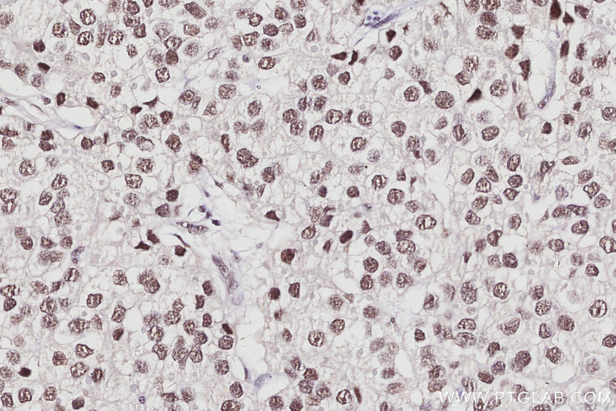 IHC staining of human stomach cancer using 16615-1-AP IHC staining of human stomach cancer using 16615-1-AP