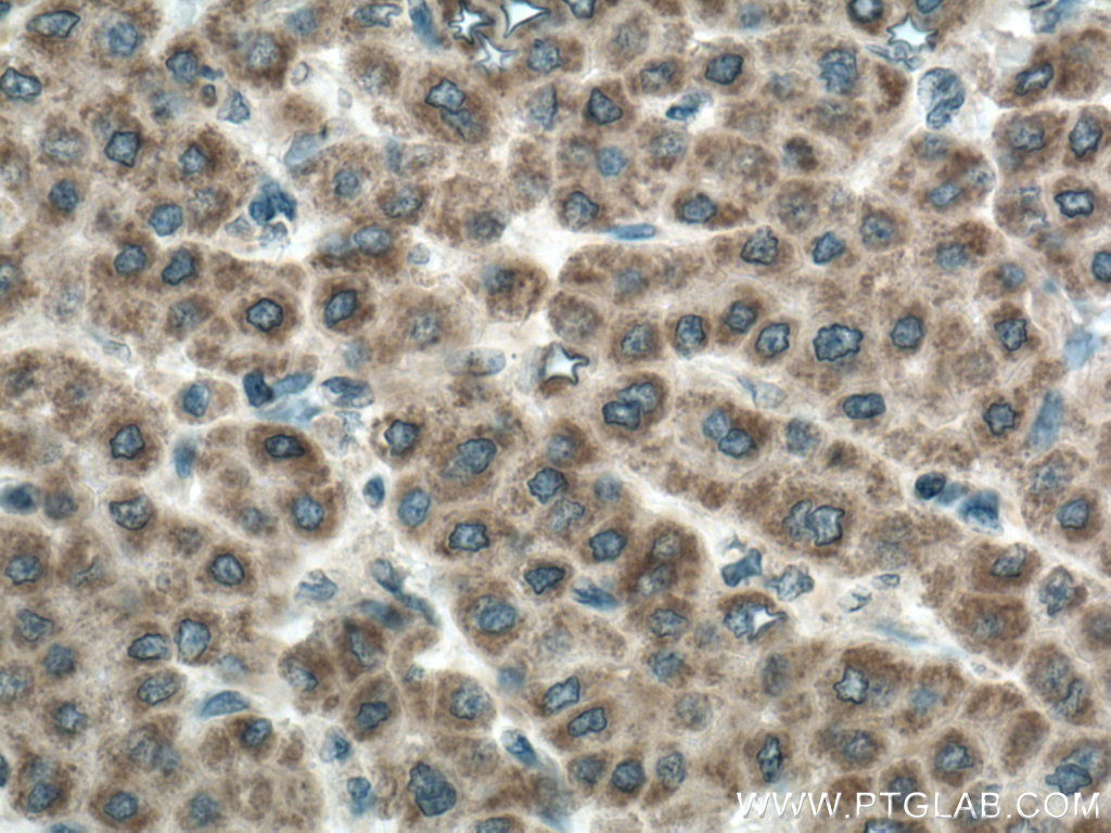 IHC staining of human liver cancer using 12589-1-AP