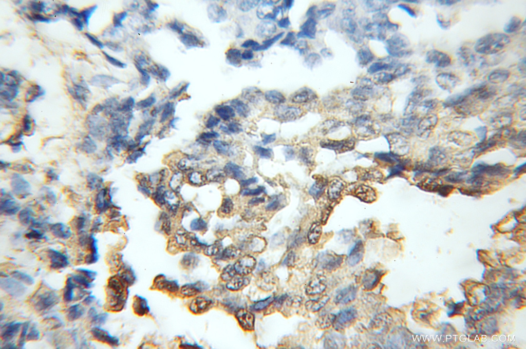 IHC staining of human breast cancer using 11611-2-AP