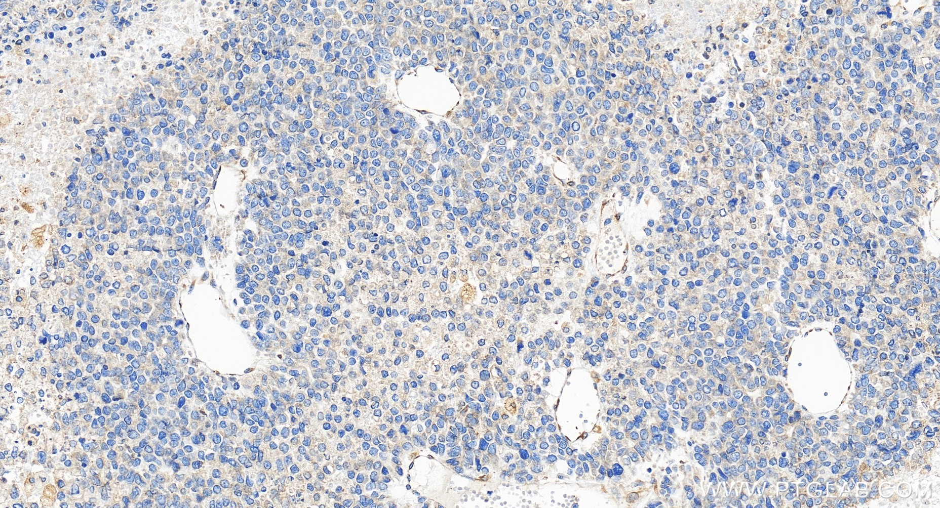 IHC staining of human liver cancer using 85162-4-RR