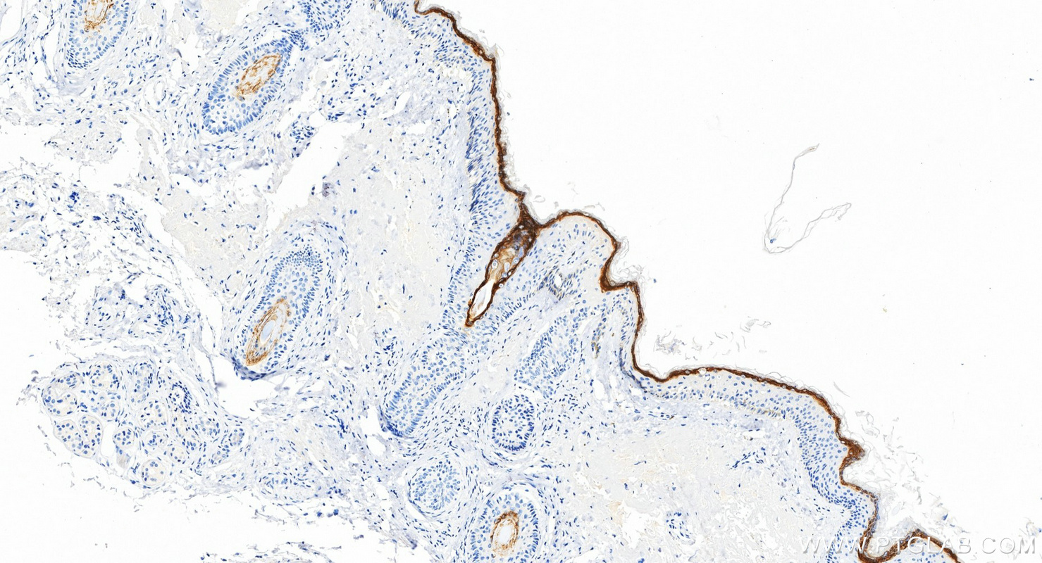 IHC staining of human skin cancer using 85384-2-RR (same clone as 85384-2-PBS) IHC staining of human skin cancer using 85384-2-RR (same clone as 85384-2-PBS)