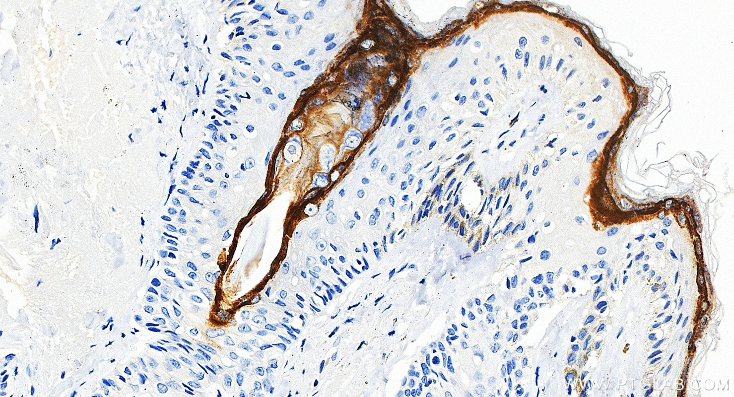 IHC staining of human skin cancer using 85384-2-RR (same clone as 85384-2-PBS) IHC staining of human skin cancer using 85384-2-RR (same clone as 85384-2-PBS)