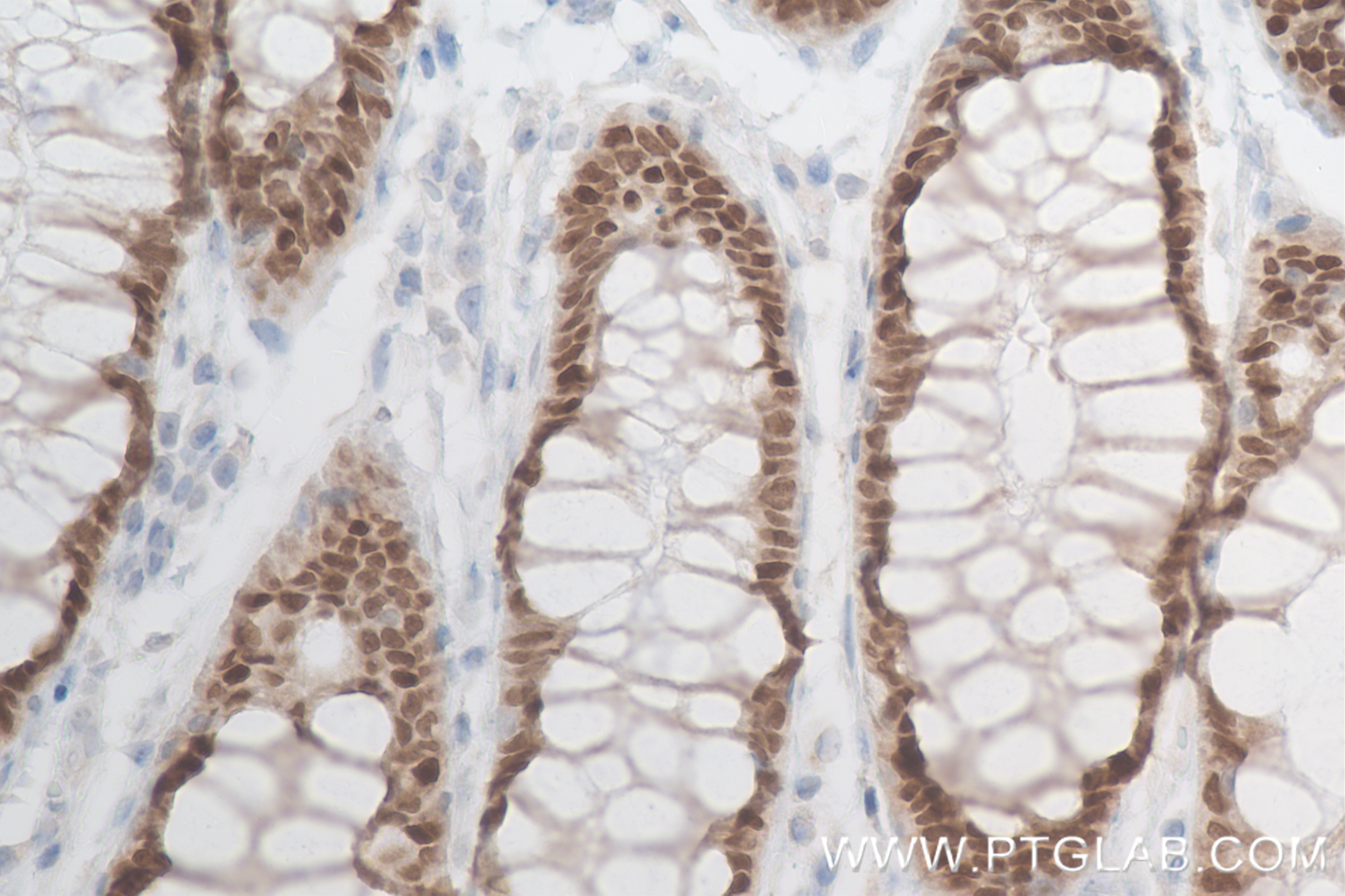 IHC staining of human rectal cancer using 82659-1-RR