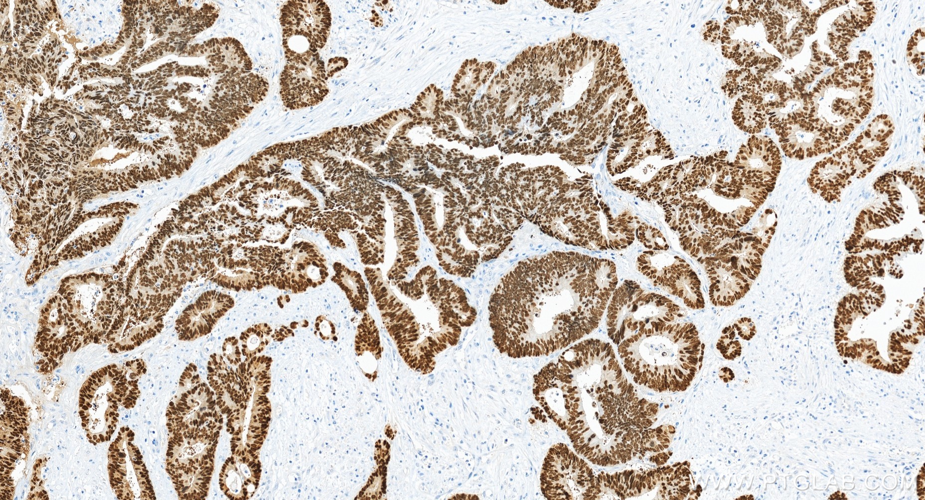 IHC staining of human colon cancer using 82663-1-RR IHC staining of human colon cancer using 82663-1-RR