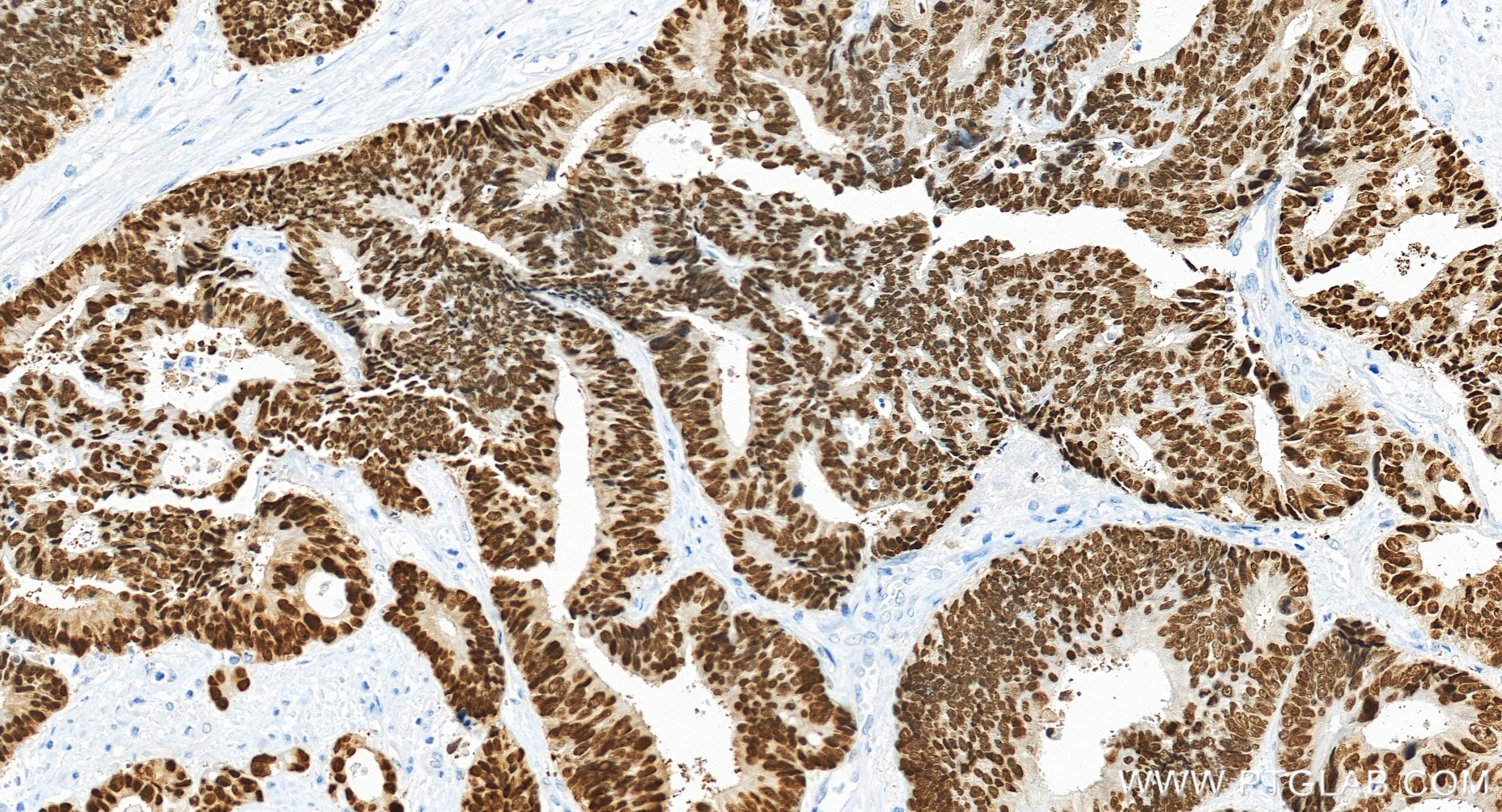 IHC staining of human colon cancer using 82663-1-RR IHC staining of human colon cancer using 82663-1-RR