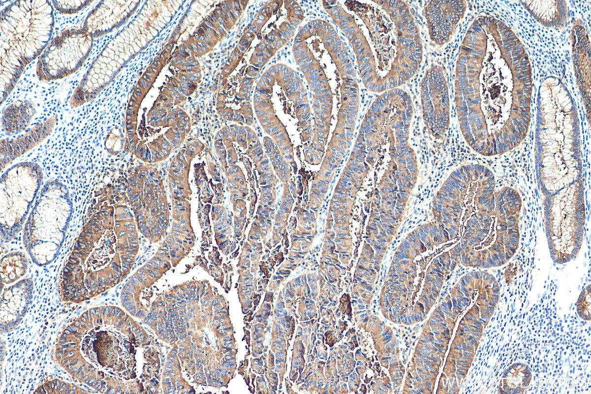 IHC staining of human colon cancer using 68377-1-Ig (same clone as 68377-1-PBS)