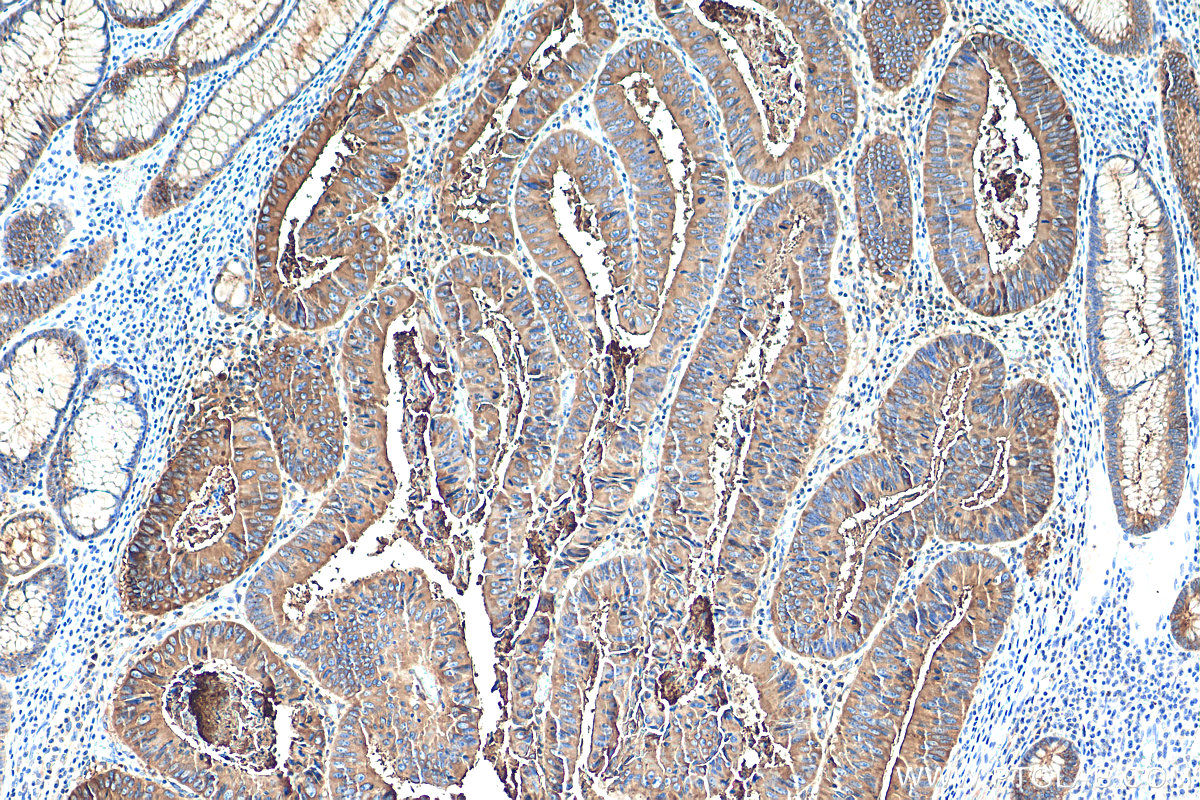 IHC staining of human colon cancer using 68377-1-Ig