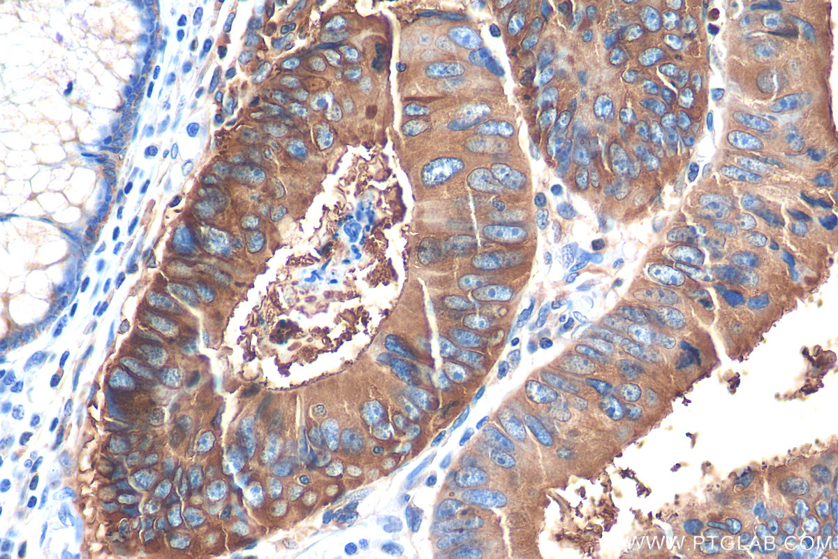 IHC staining of human colon cancer using 68377-1-Ig (same clone as 68377-1-PBS)