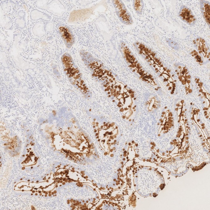IHC staining of human stomach cancer using 68377-1-Ig