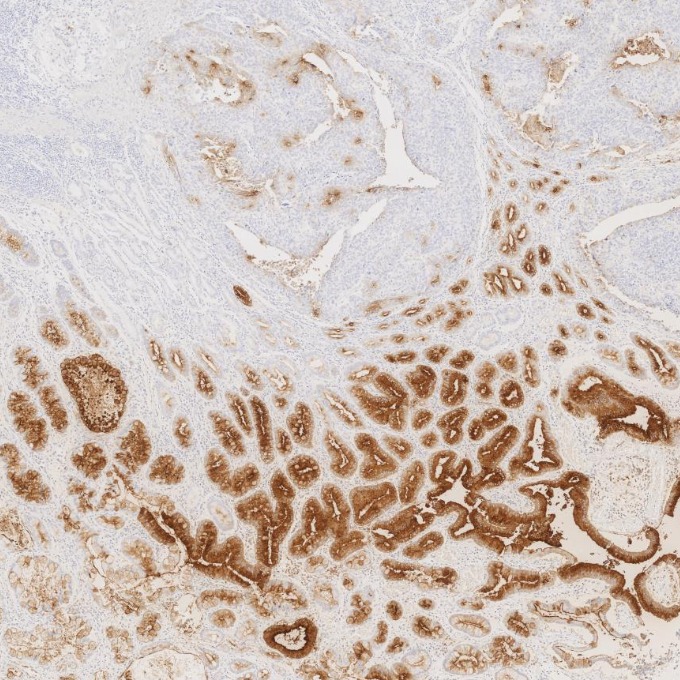 IHC staining of human stomach cancer using 68377-1-Ig