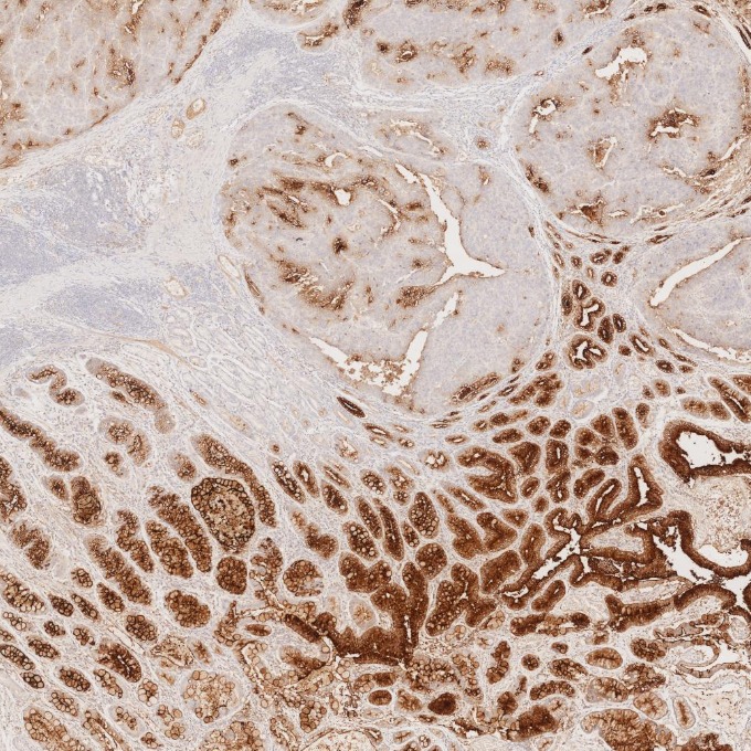 IHC staining of human stomach cancer using 68377-1-Ig