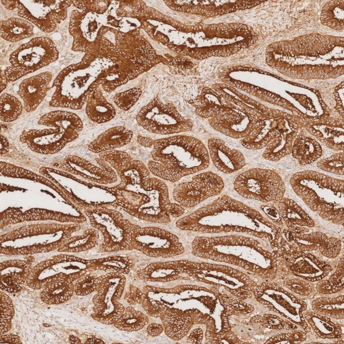 IHC staining of human colorectal cancer using 68377-1-Ig