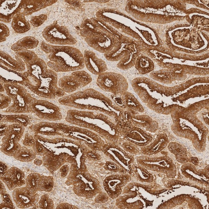 IHC staining of human colorectal cancer using 68377-1-Ig