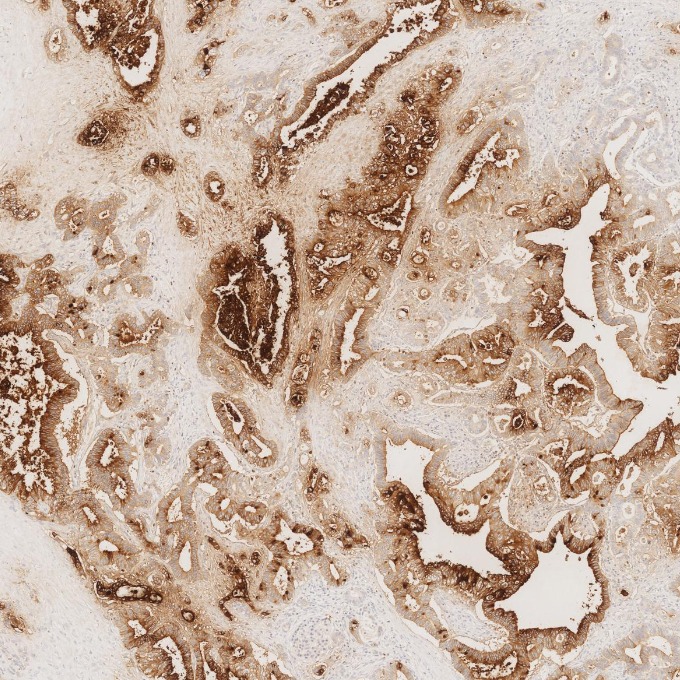 IHC staining of human pancreas cancer using 68377-1-Ig