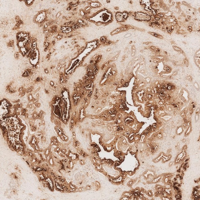 IHC staining of human pancreas cancer using 68377-1-Ig