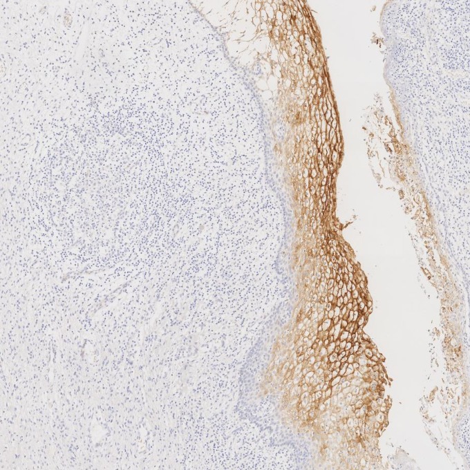 IHC staining of human cervical cancer using 68377-1-Ig
