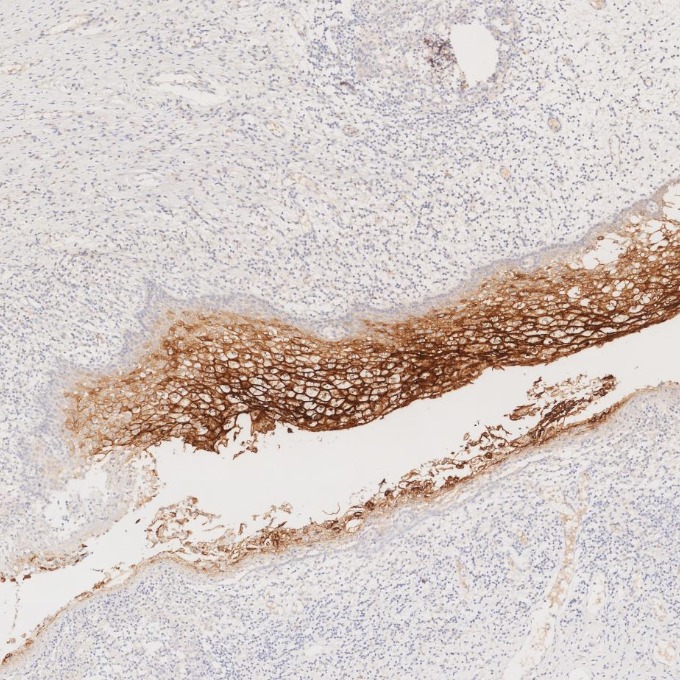 IHC staining of human cervical cancer using 68377-1-Ig