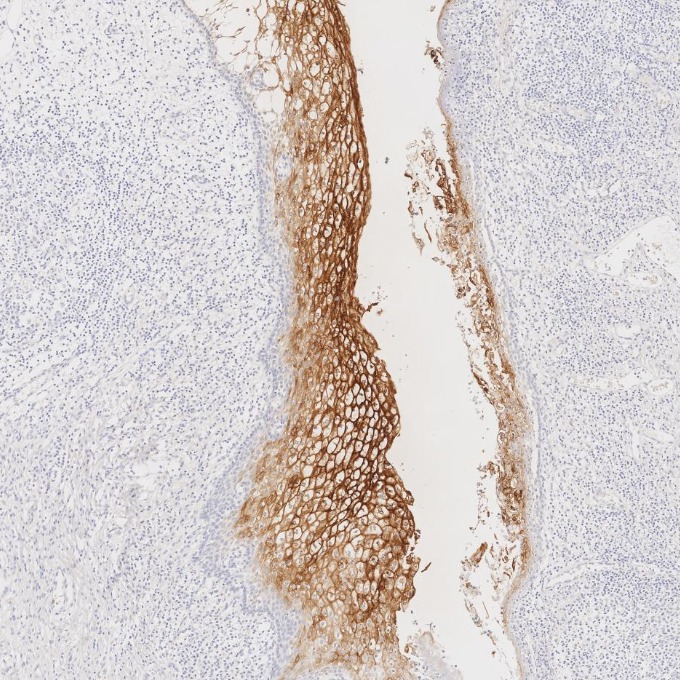 IHC staining of human cervical cancer using 68377-1-Ig