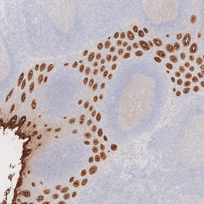 IHC staining of human appendicitis using 68377-1-Ig