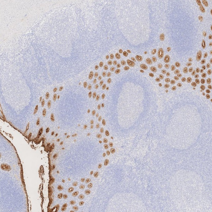 IHC staining of human appendicitis using 68377-1-Ig