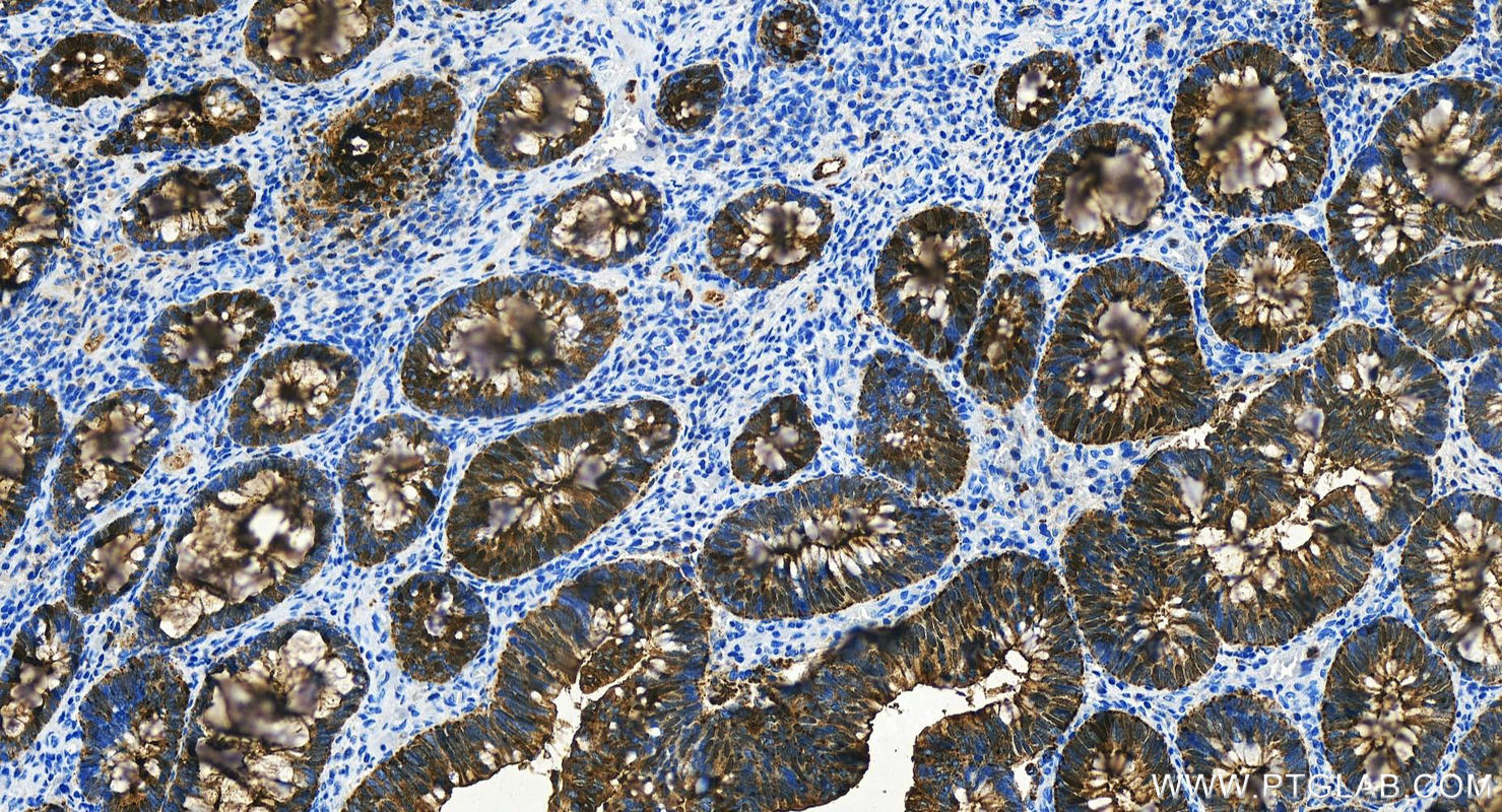 IHC staining of human colon cancer using 31519-1-AP