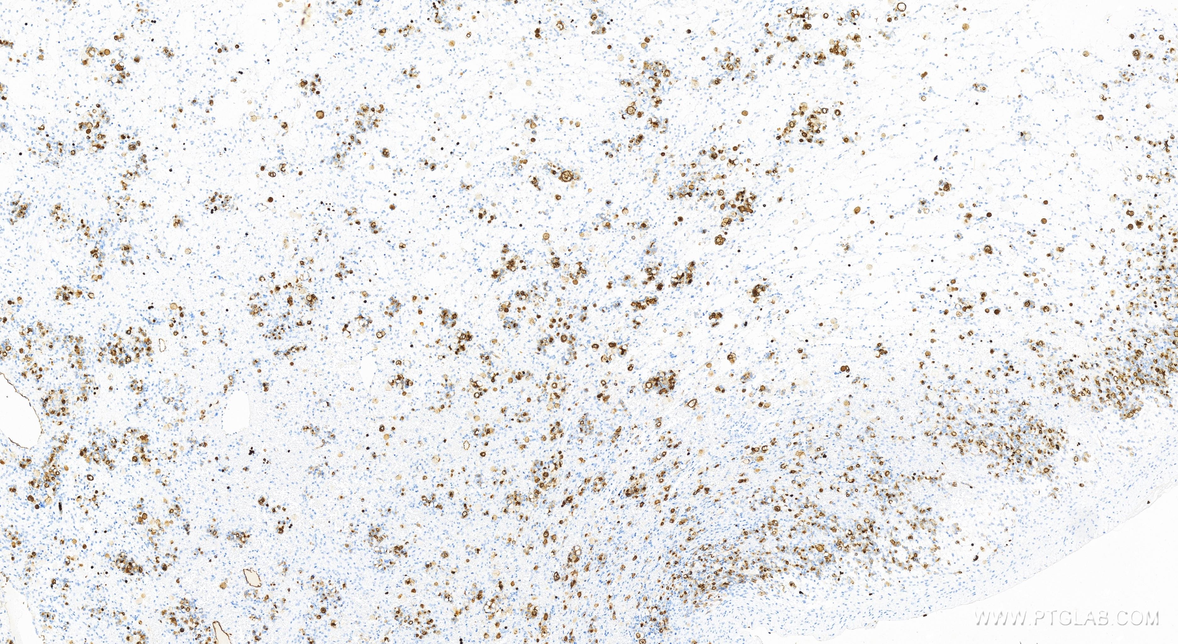 IHC staining of human ovary cancer using 83524-3-RR (same clone as 83524-3-PBS)
