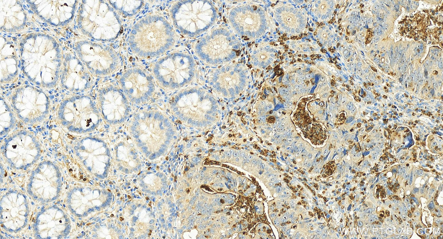 IHC staining of human colon cancer using 22238-1-AP