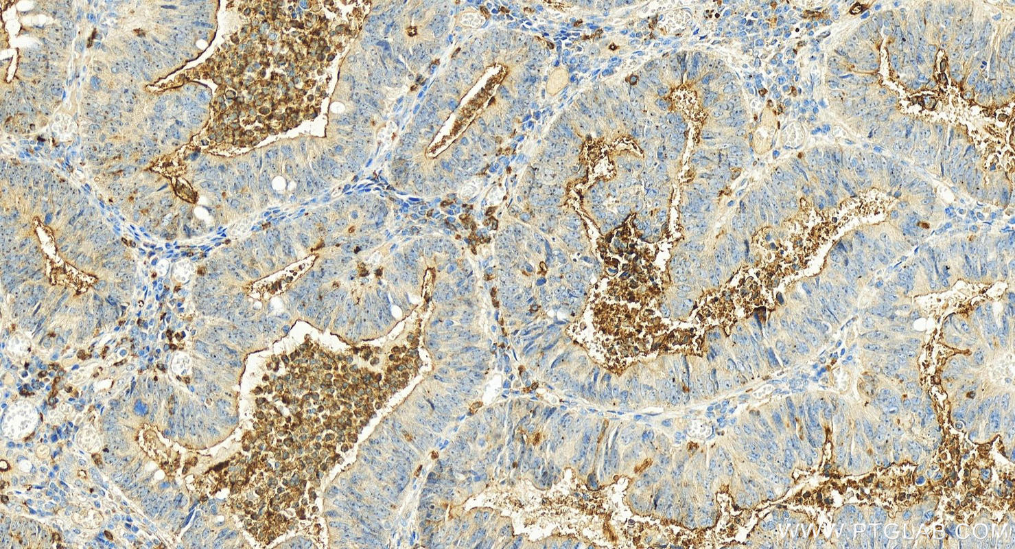 IHC staining of human colon cancer using 22238-1-AP