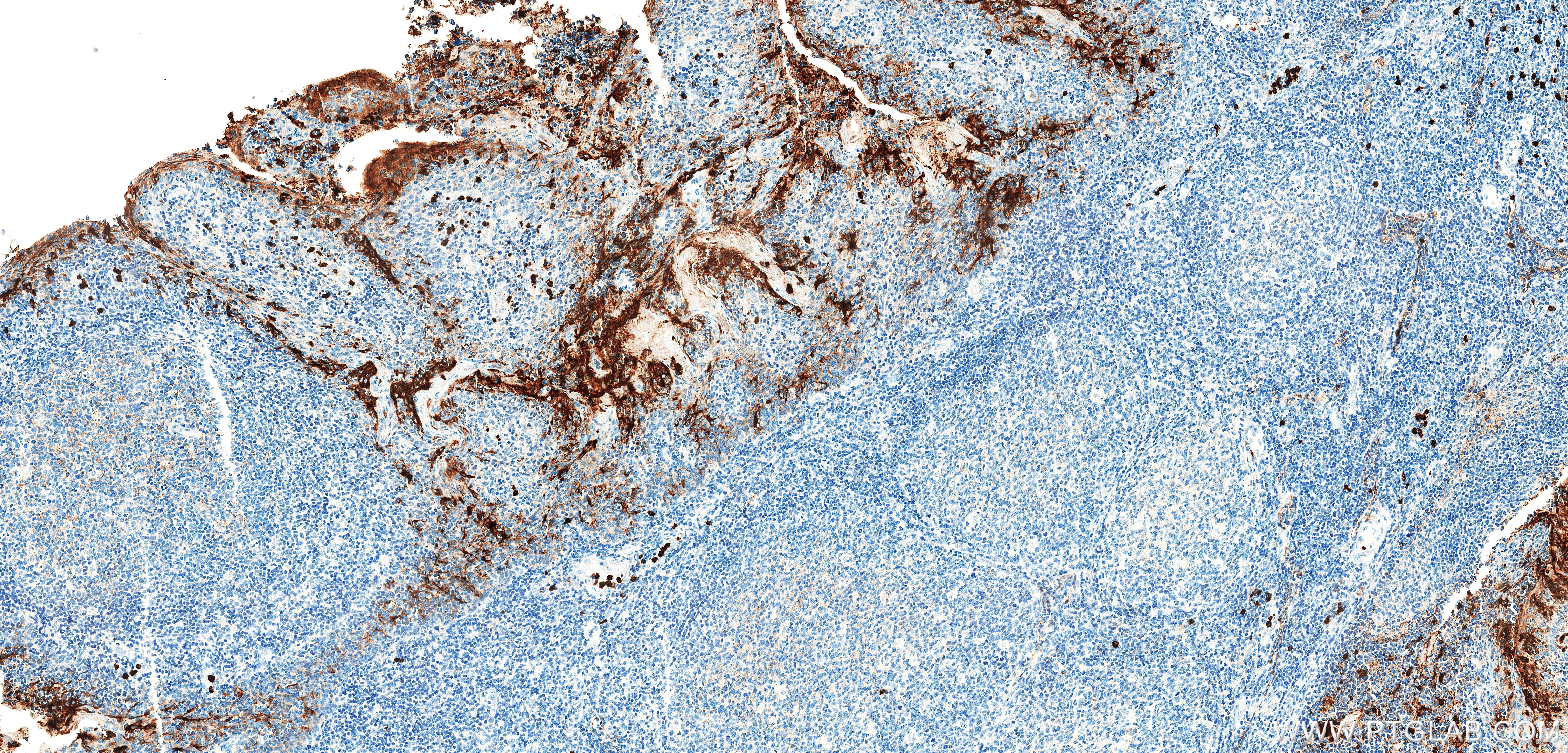 IHC staining of human tonsil using 83524-8-RR IHC staining of human tonsil using 83524-8-RR
