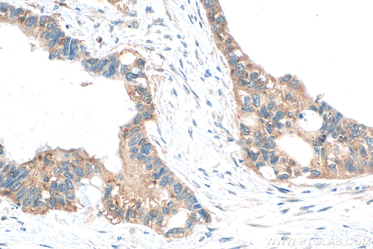 IHC staining of human urothelial carcinoma using 32196-1-AP