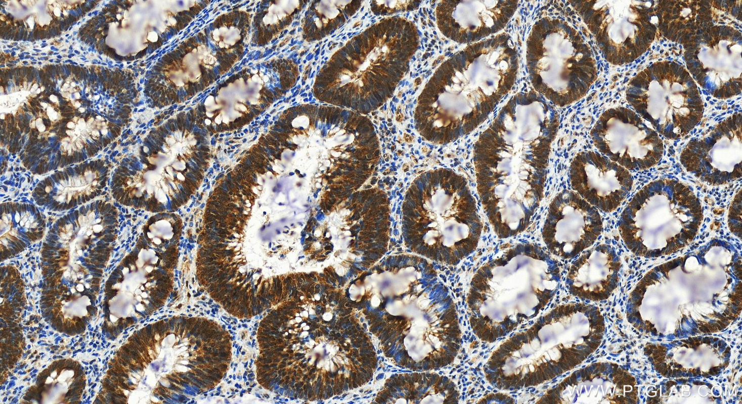 IHC staining of human colon cancer using 19496-1-AP