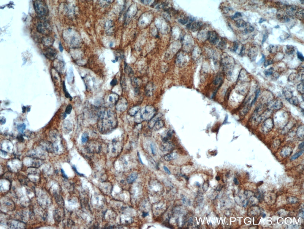 IHC staining of human colon cancer using 19496-1-AP