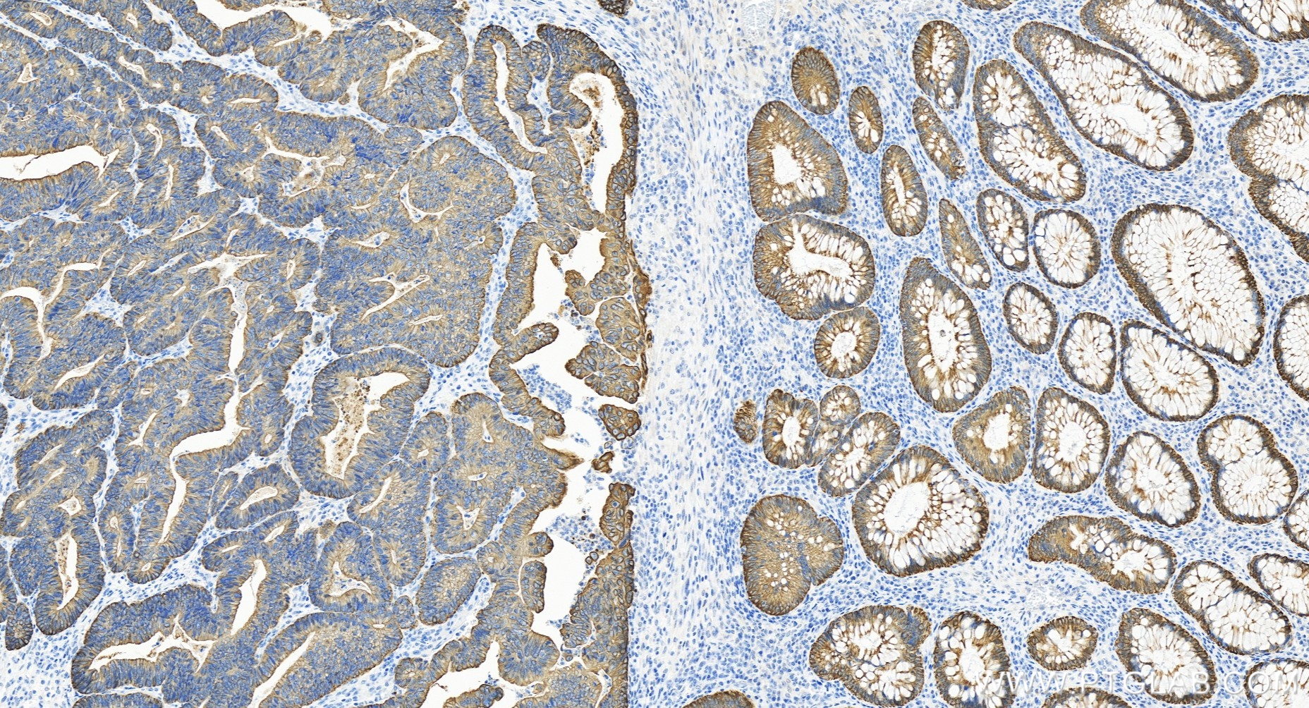 IHC staining of human colon cancer using 84982-1-RR
