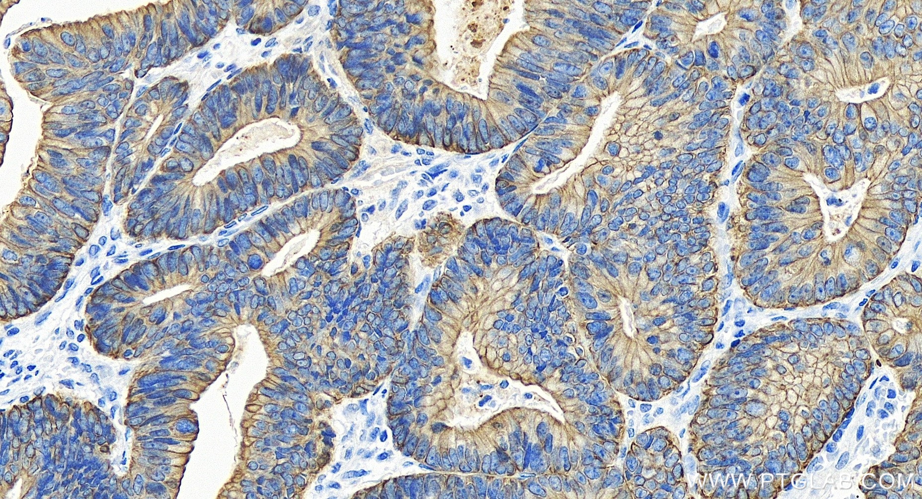 IHC staining of human colon cancer using 84982-1-RR