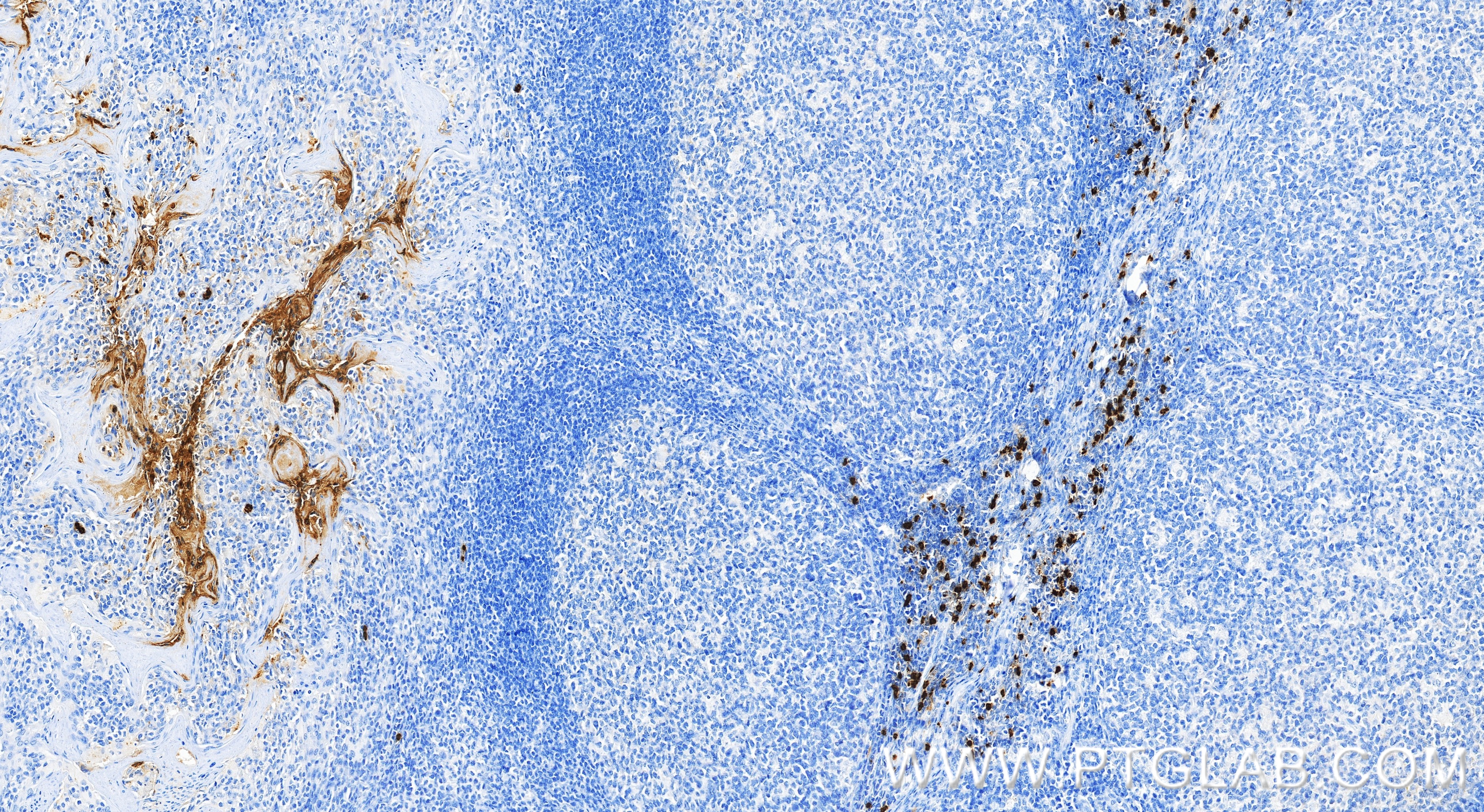 Immunohistochemical analysis of paraffin-embedded human tonsillitis tissue slide using 83105-6-RR (CEACAM8/CD66b antibody) at dilution of 1:10000 (under 20x lens). Heat mediated antigen retrieval with Tris-EDTA buffer (pH 9.0). IHC staining of human tonsillitis using 83105-6-RR