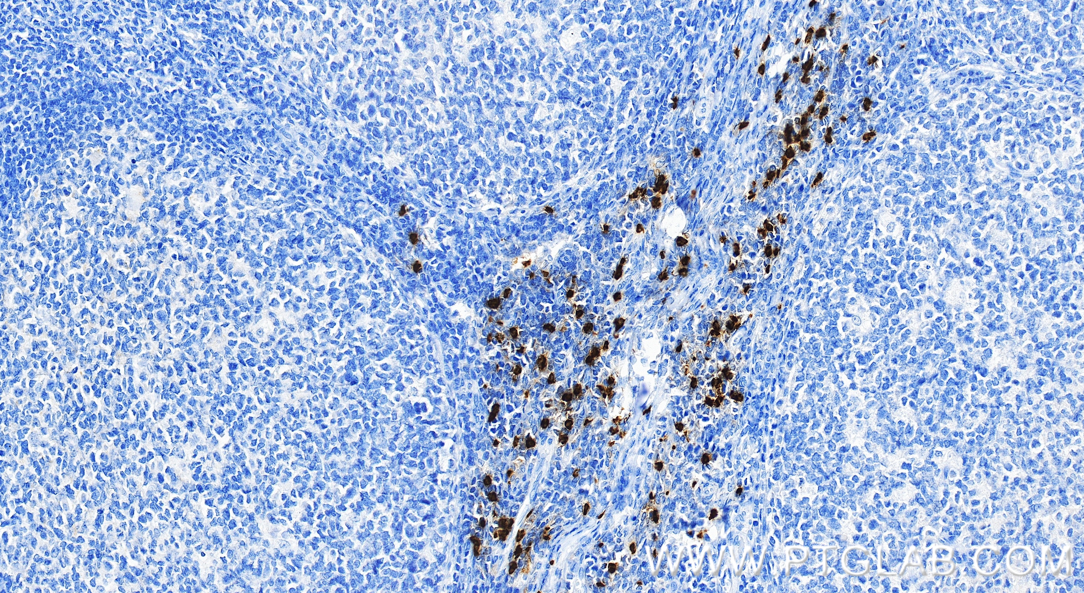 Immunohistochemical analysis of paraffin-embedded human tonsillitis tissue slide using 83105-6-RR (CEACAM8/CD66b antibody) at dilution of 1:10000 (under 20x lens). Heat mediated antigen retrieval with Tris-EDTA buffer (pH 9.0). IHC staining of human tonsillitis using 83105-6-RR