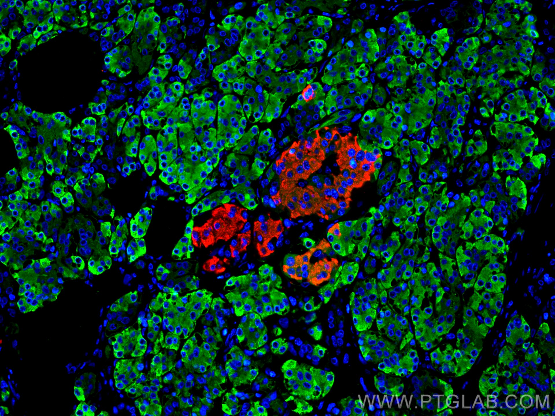 IF Staining of human pancreas cancer using 15384-1-AP