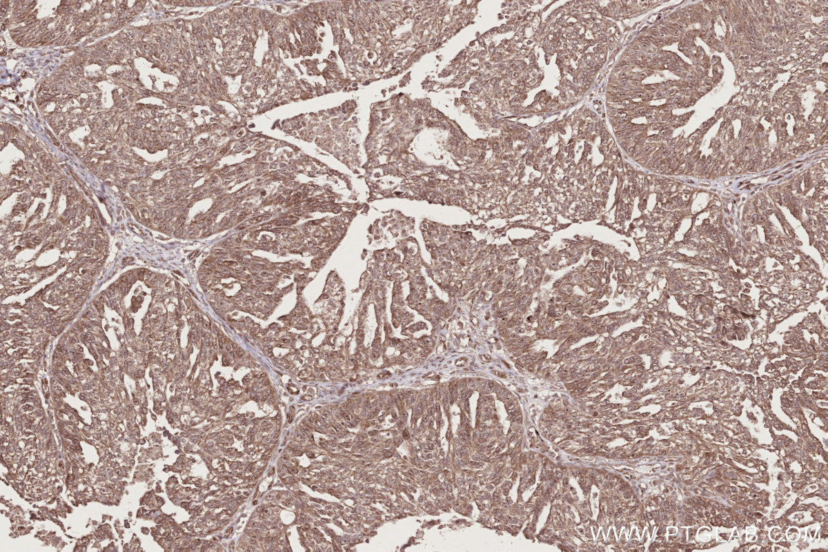 IHC staining of human ovary cancer using 28700-1-AP