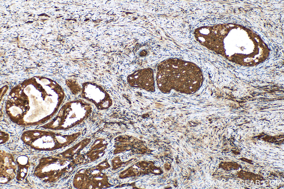 IHC staining of human prostate cancer using 30446-1-AP