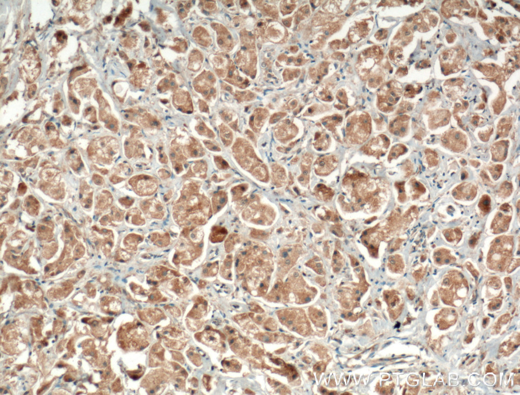 IHC staining of human breast cancer using 55341-1-AP