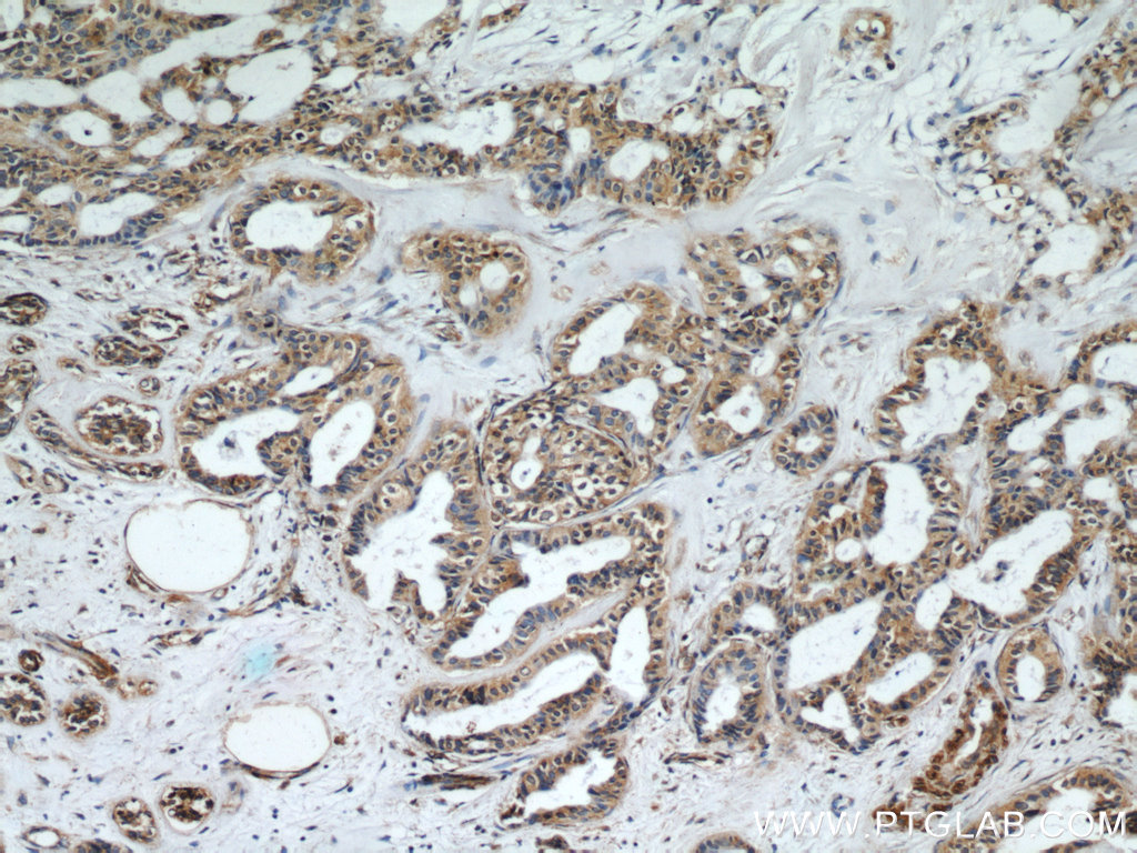 IHC staining of human breast cancer using 22050-1-AP