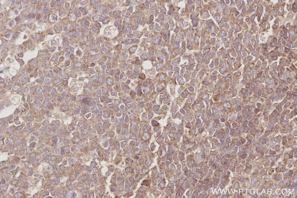 Immunohistochemical analysis of paraffin-embedded human tonsillitis tissue slide using 20496-1-AP (CEPT1 antibody) at dilution of 1:1000 (under 40x lens). Heat mediated antigen retrieval with Tris-EDTA buffer (pH 9.0). IHC staining of human tonsillitis using 20496-1-AP