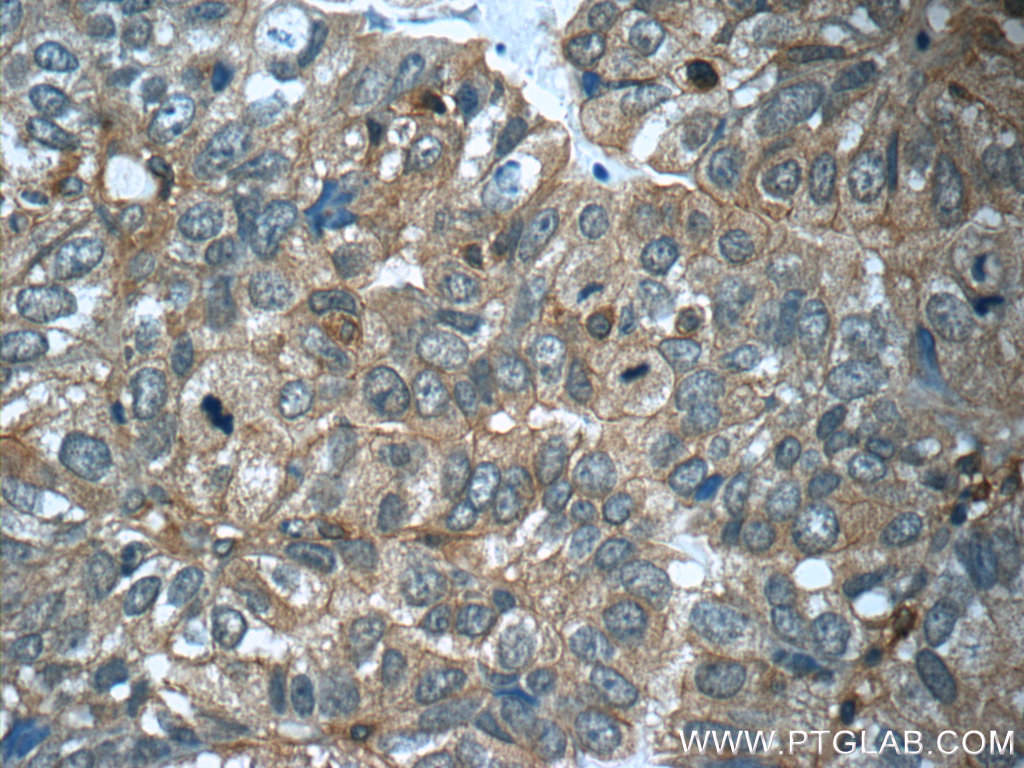 IHC staining of human breast cancer using 20738-1-AP