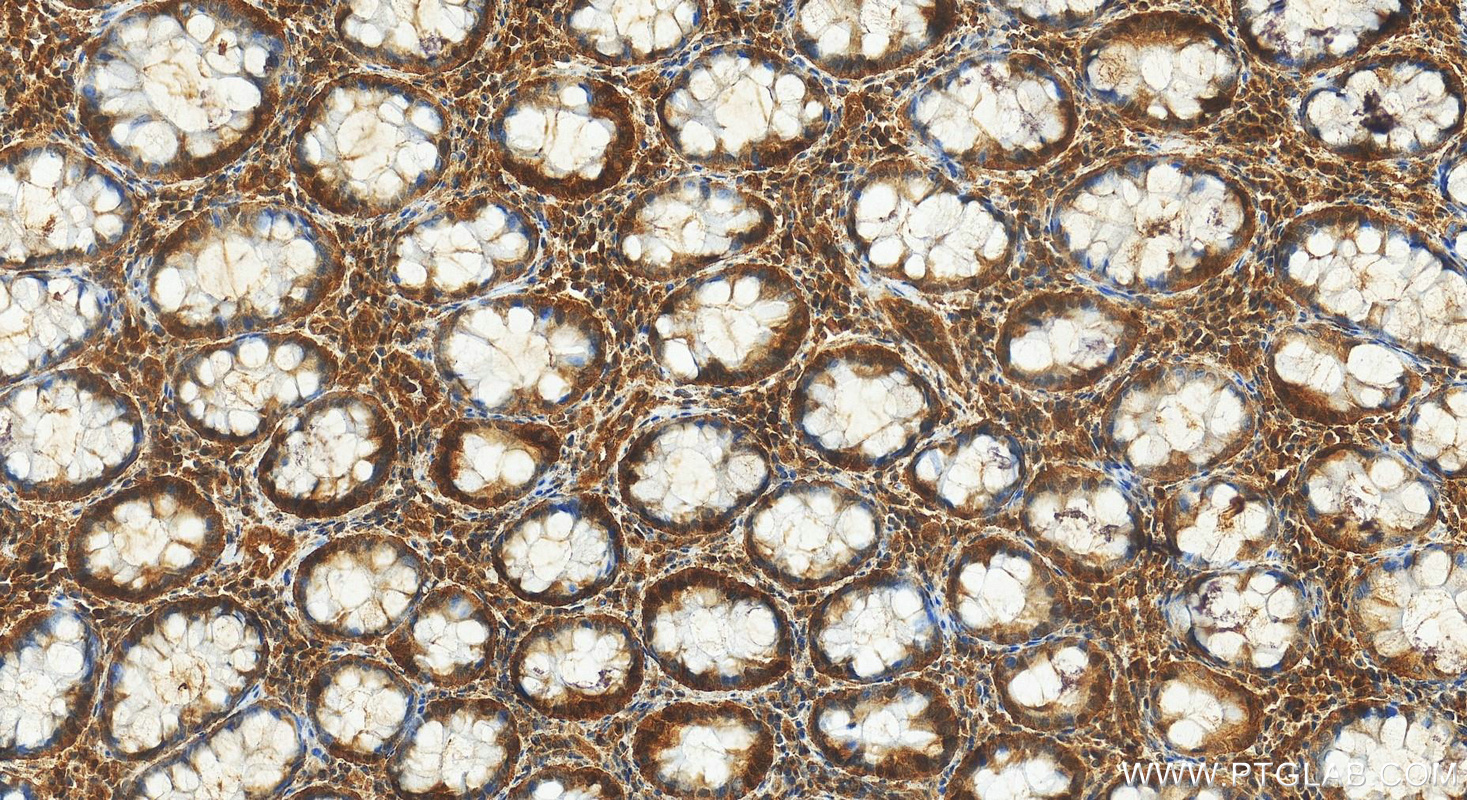 Immunohistochemical analysis of paraffin-embedded human colon cancer tissue slide using 17037-1-AP (CHAF1A antibody) at dilution of 1:200 (under 20x lens). Heat mediated antigen retrieval with Tris-EDTA buffer (pH 9.0). IHC staining of human colon cancer using 17037-1-AP