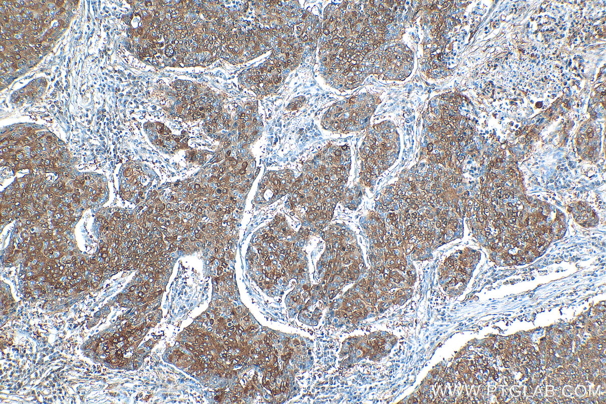Immunohistochemical analysis of paraffin-embedded human lung cancer tissue slide using 20747-1-AP (CHAT antibody) at dilution of 1:400 (under 10x lens). Heat mediated antigen retrieval with Tris-EDTA buffer (pH 9.0). IHC staining of human lung cancer using 20747-1-AP