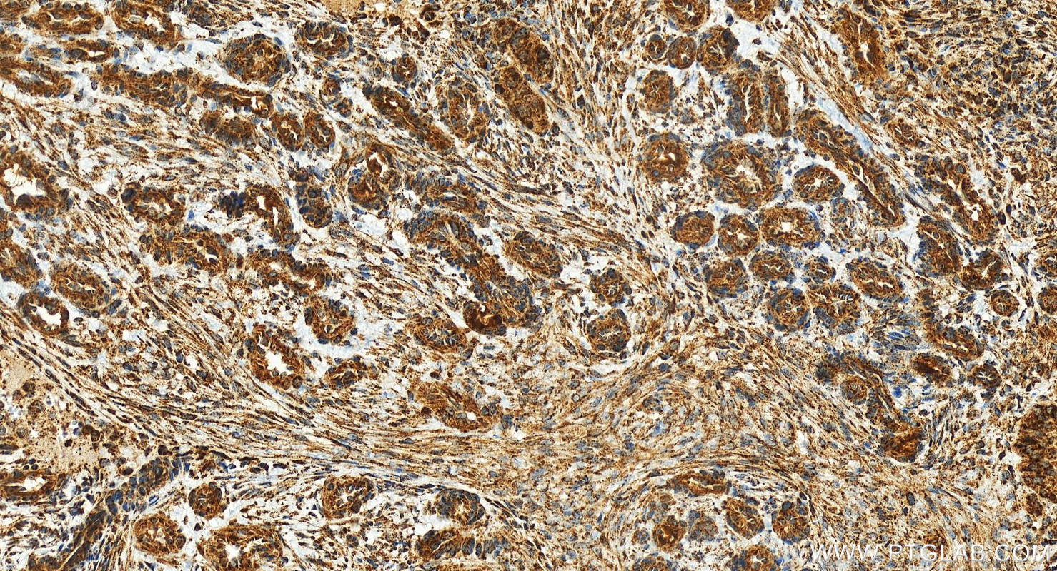 Immunohistochemical analysis of paraffin-embedded human ovarian cancer slide using <a class='green' href='/productredirect?CatalogNo=25711-1-AP' target='_blank'>25711-1-AP</a> (CHCHD5 antibody) at dilution of 1:200 (under 20x lens). Heat mediated antigen retrieval with Tris-EDTA buffer (pH 9.0). This data was developed using the same antibody clone with 25711-1-PBS in a different storage buffer formulation. IHC staining of human ovarian cancer using 25711-1-AP (same clone as 25711-1-PBS)