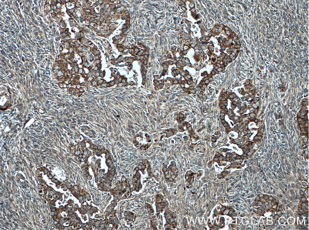 IHC staining of human ovary tumor using 66584-1-Ig