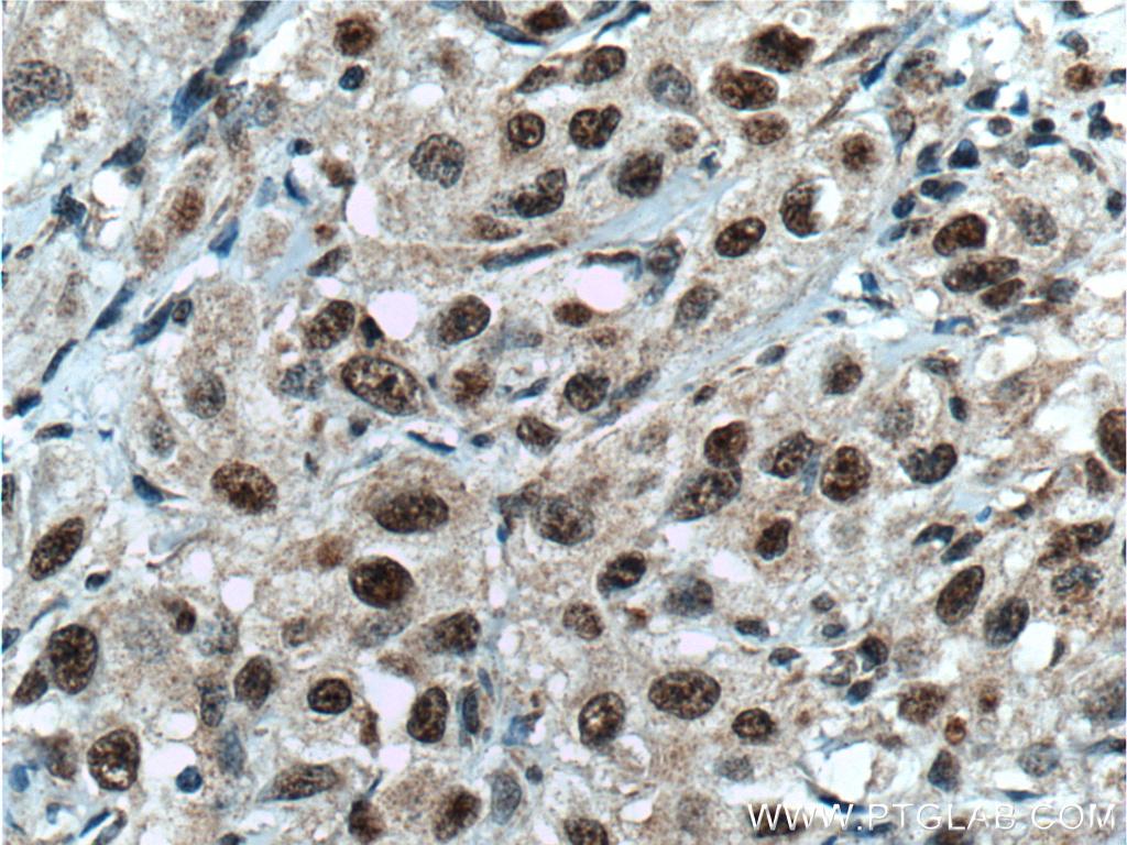 IHC staining of human cervical cancer using 66222-1-Ig (same clone as 66222-1-PBS)
